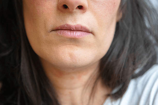 Medicated lip balm for cracked lips